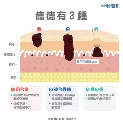 長痣的原因